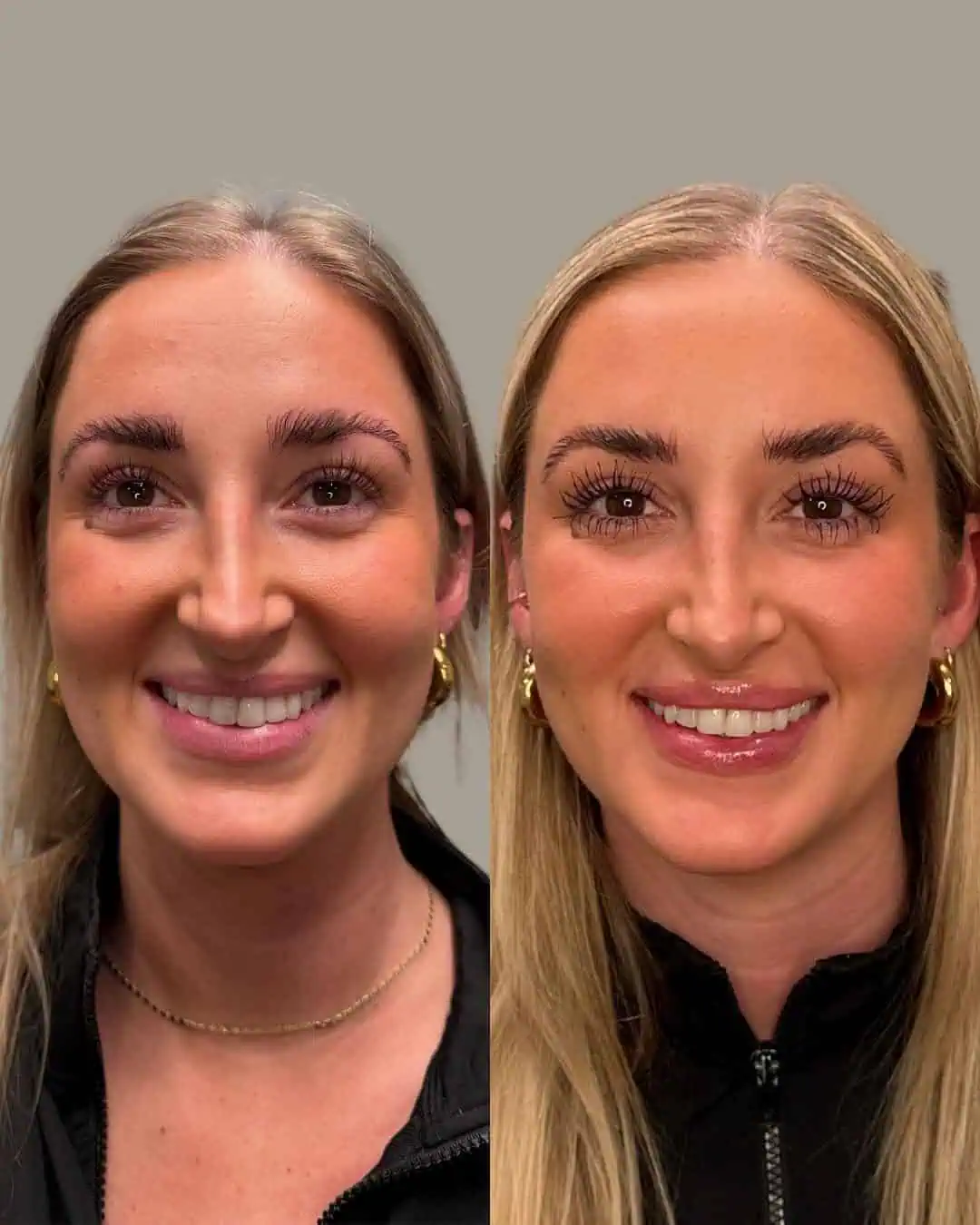 Before and After Images | Front Face | Facial Balancing in Grants Pass, OR | Renu Aesthetics