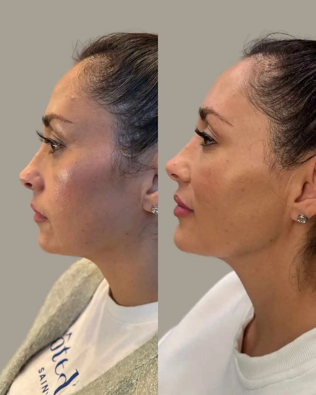 Before and After Images | Facial Balancing in Grants Pass, OR | Left Face | Renu Aesthetics