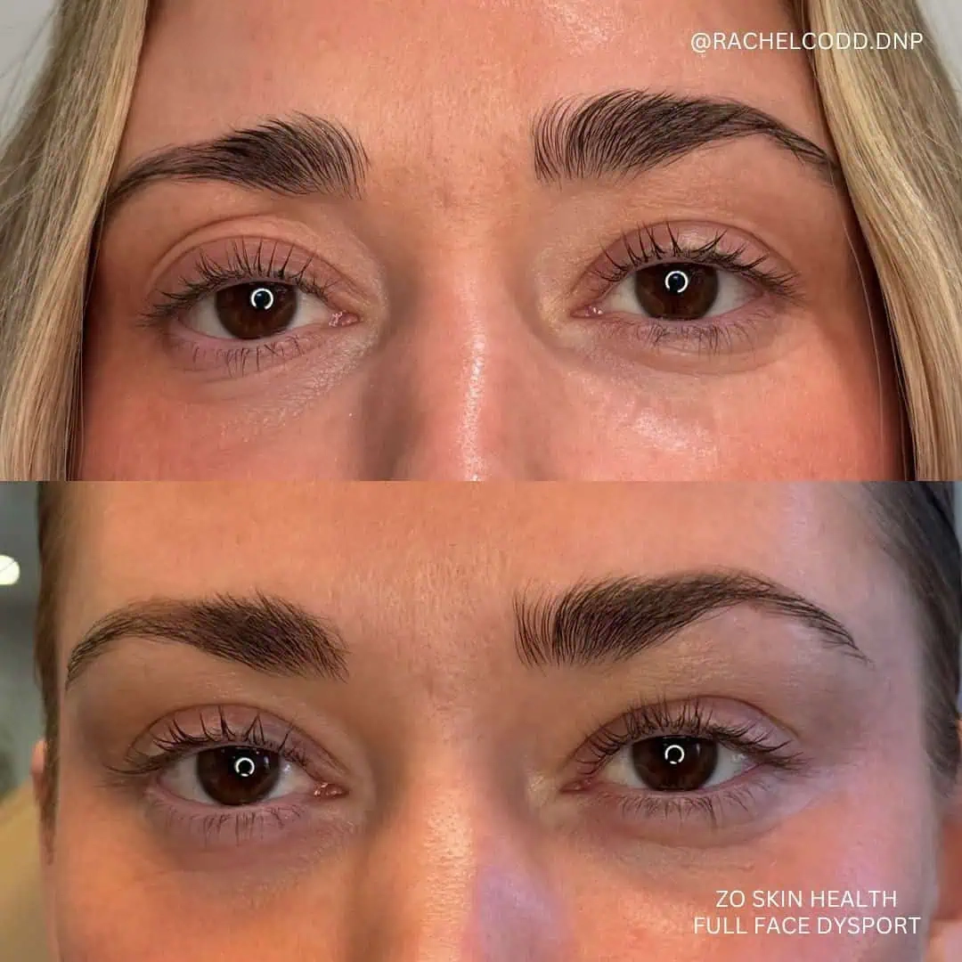 zo-skin-health-full-face-dysport-before-after-rava-medical
