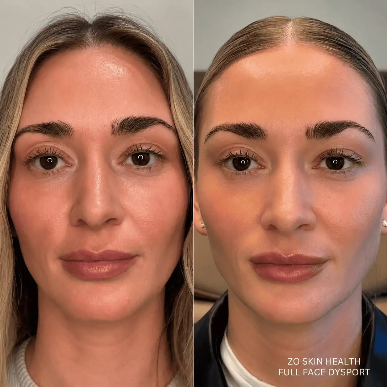 zo-skin-health-full-face-dysport-by-rava-medical