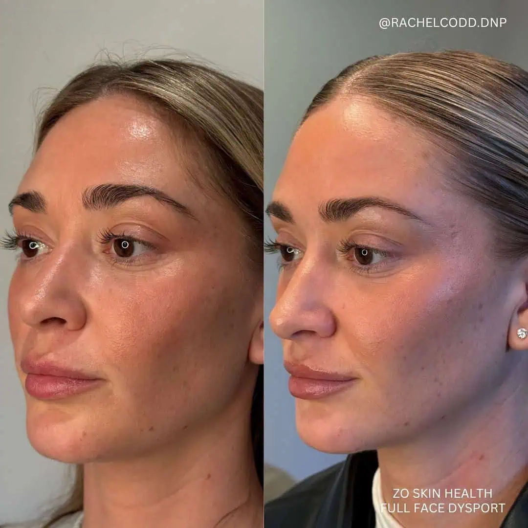 zo-skin-health-full-face-dysport_2-before-after-by-rava-medical